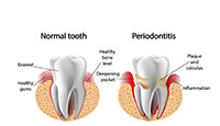 Periodontal Image