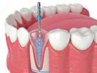 Root Canal Image